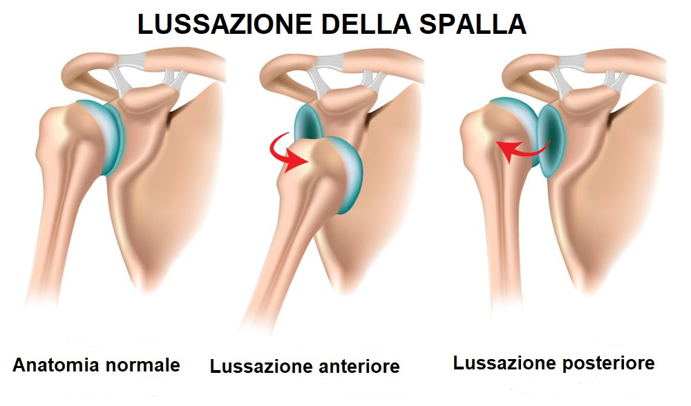 Dislocazione della spalla