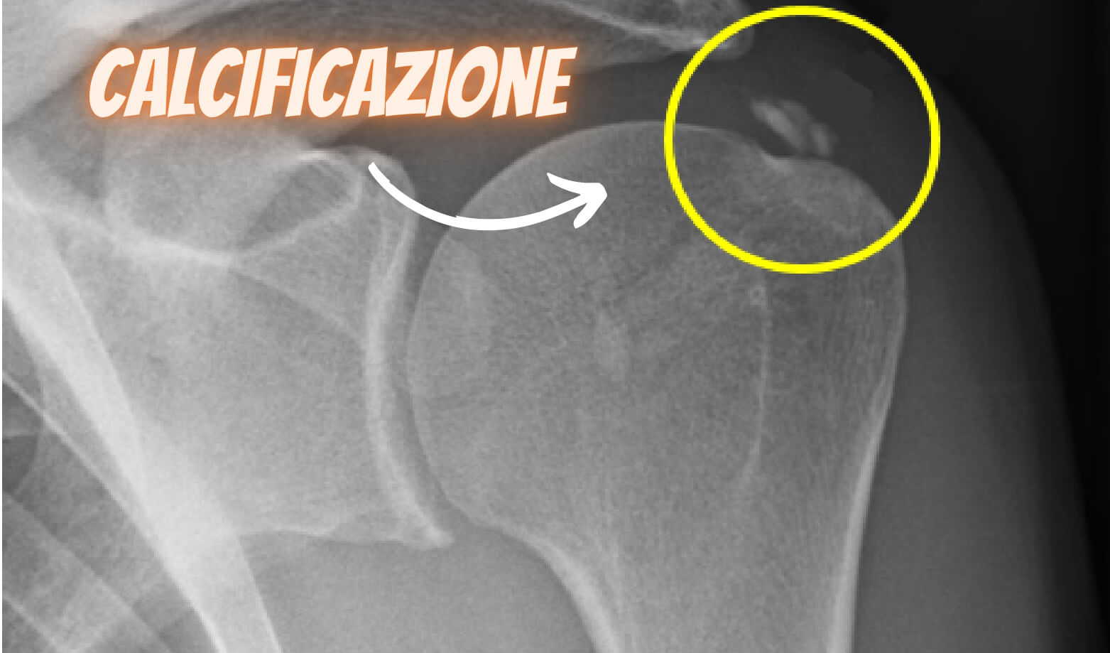 Calcificazioni alla radiografia