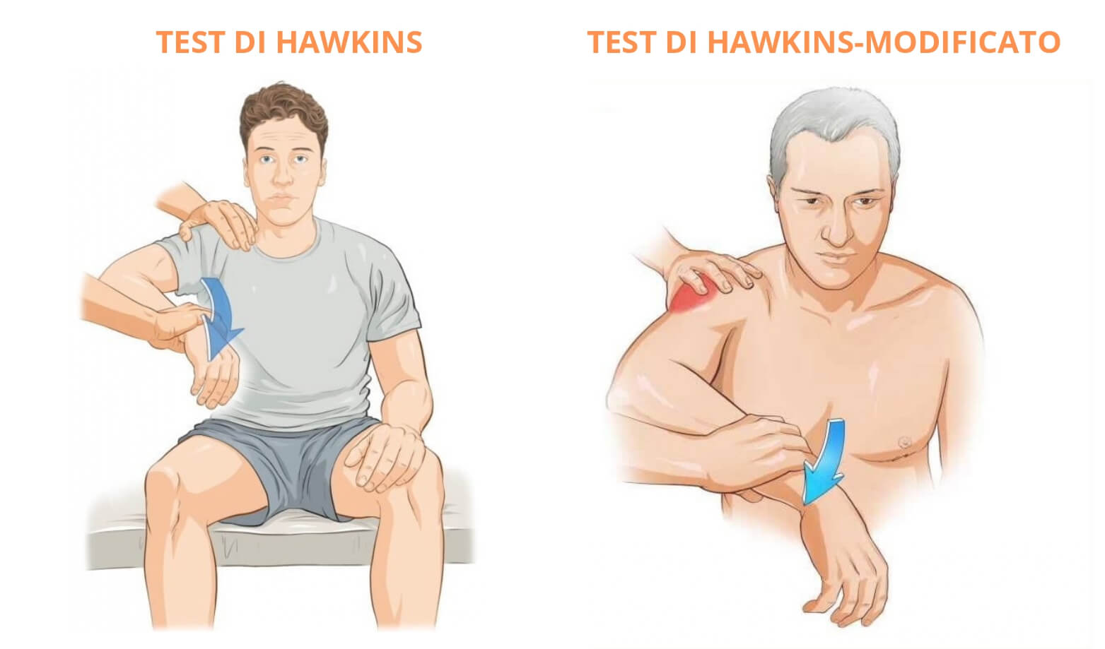 Test Impingement alla spalla Diagnosti Impingement subacromiale