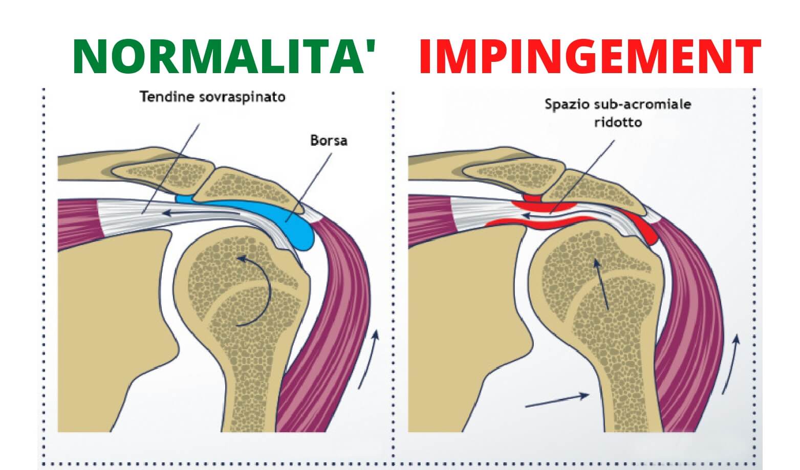 Cause Impingement alla spalla Conflitto sub acromiale