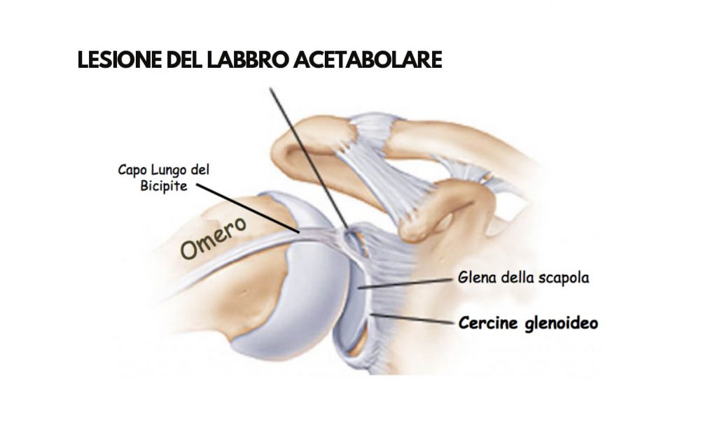 Rumori alla spalla: possibile lesione slap