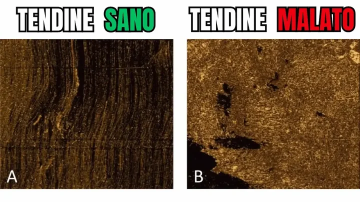Dolore alla spalla, differenza tendini sani e malati La tendinopatia è una delle cause più comuni di dolore alla spalla. Spesso non riconosciuta e non trattata correttamente.